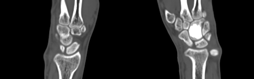 Bone islands - carpus (Radiopaedia 63141-71658 Coronal bone window 32).jpg