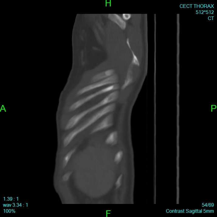 Bone metastases from lung carcinoma (Radiopaedia 54703-60937 Sagittal bone window 54).jpg
