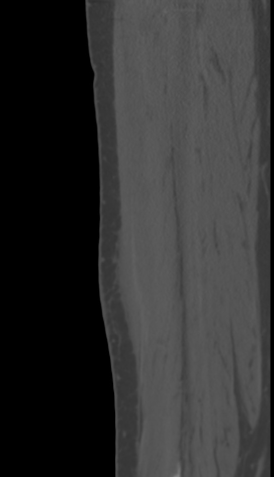 Bone metastasis - tibia (Radiopaedia 57665-64609 Sagittal bone window 129).jpg