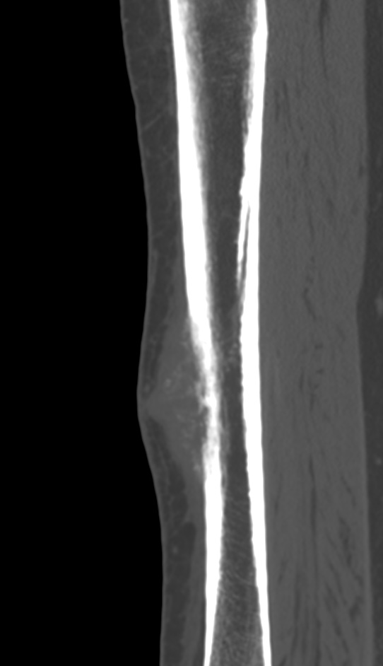 Bone metastasis - tibia (Radiopaedia 57665-64609 Sagittal bone window 74).jpg