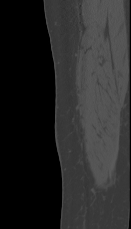 Bone metastasis - tibia (Radiopaedia 57665-64609 Sagittal bone window 8).jpg