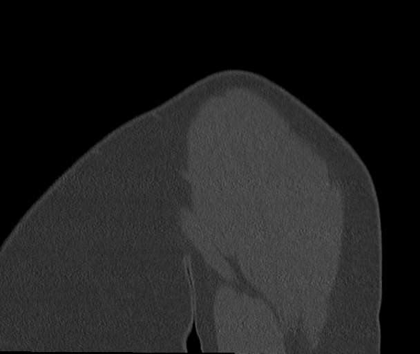 Bony Bankart and Hill-Sachs lesions (Radiopaedia 33622-34727 Sagittal bone window 8).png