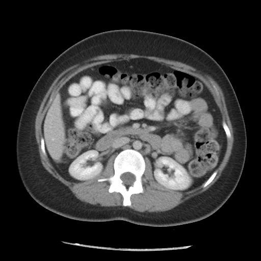 File:Borderline mucinous tumor (ovary) (Radiopaedia 78228-90808 A 85).jpg
