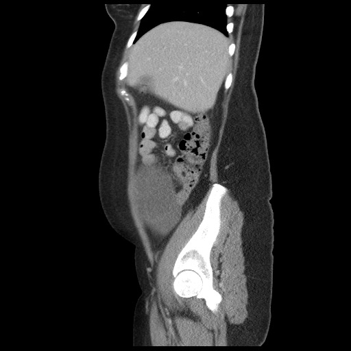 File:Borderline mucinous tumor (ovary) (Radiopaedia 78228-90808 B 18).jpg