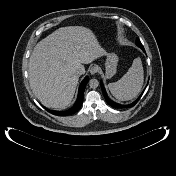 Bosniak renal cyst - type IV (Radiopaedia 24244-24518 Axial non-contrast 67).jpg