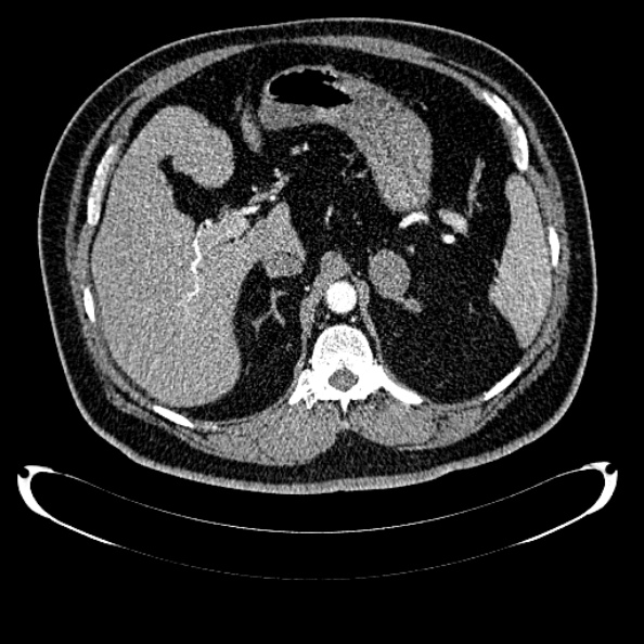 Bosniak renal cyst - type IV (Radiopaedia 24244-24518 B 81).jpg