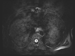 File:Bouveret syndrome (Radiopaedia 61017-68856 Axial MRCP 6).jpg