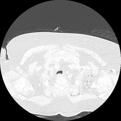 Bovine aortic arch - right internal mammary vein drains into the superior vena cava (Radiopaedia 63296-71875 Axial lung window 16).jpg