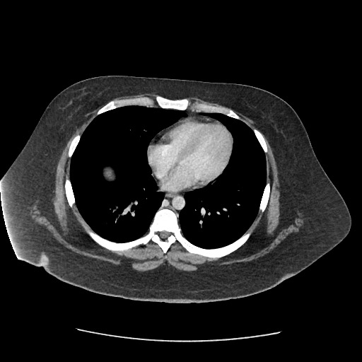 Bowel and splenic infarcts in acute lymphocytic leukemia (Radiopaedia 61055-68915 A 10).jpg