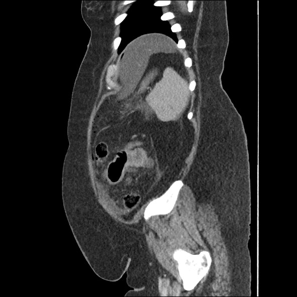 Bowel and splenic infarcts in acute lymphocytic leukemia (Radiopaedia 61055-68915 C 16).jpg