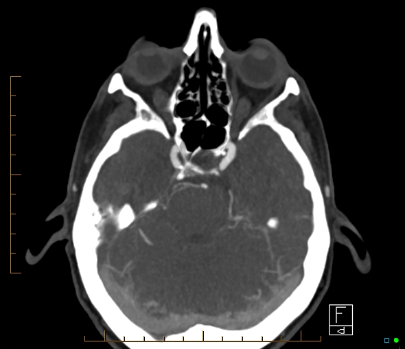 Brachiocephalic trunk stenosis (Radiopaedia 87242-103519 A 47).jpg