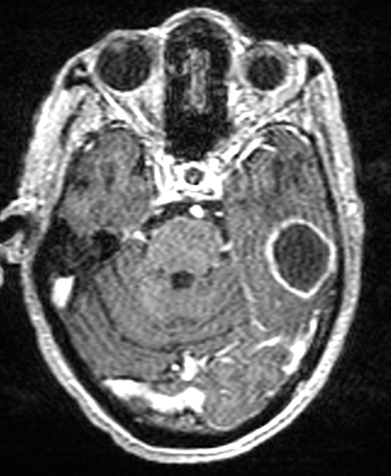 Brain abscess with dual rim sign (Radiopaedia 87566-103938 Axial T1 C+ 56).jpg