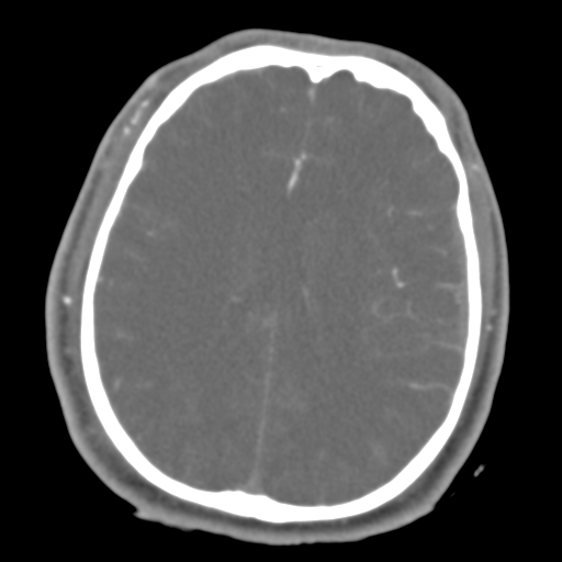 Brain contusions, internal carotid artery dissection and base of skull fracture (Radiopaedia 34089-35339 D 21).png