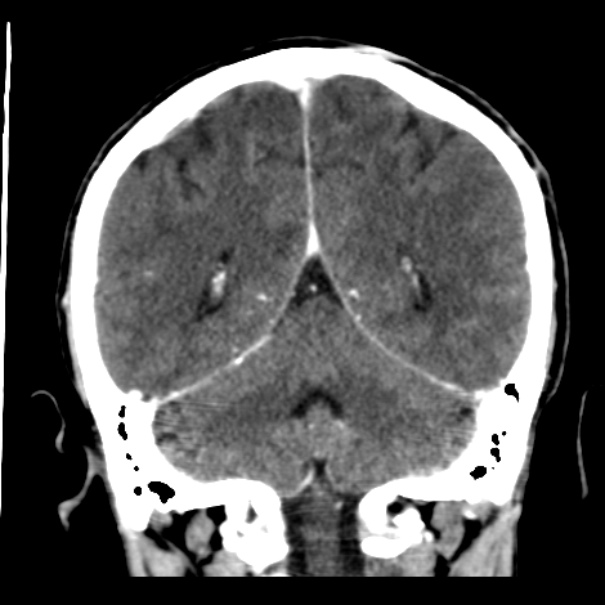 Brain metastases from lung cancer (Radiopaedia 24480-24781 Coronal C+ delayed 44).jpg