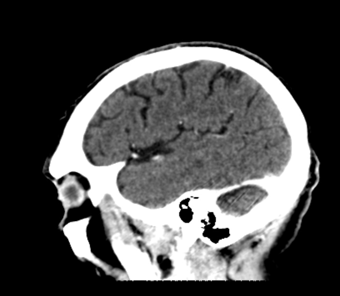 Brain metastases from lung cancer (Radiopaedia 27849-28092 Sagittal C+ delayed 49).jpg