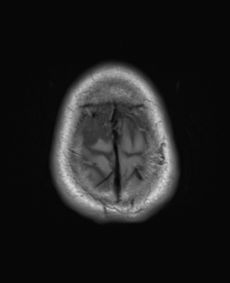 File:Brain metastasis (large cystic mass) (Radiopaedia 47497-52107 Axial T1 26).png