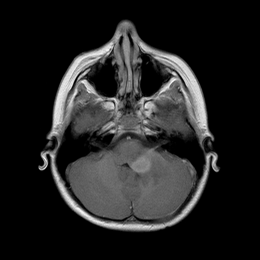 File:Brainstem ganglioglioma (Radiopaedia 10763-11224 Axial T1 C+ 10).jpg