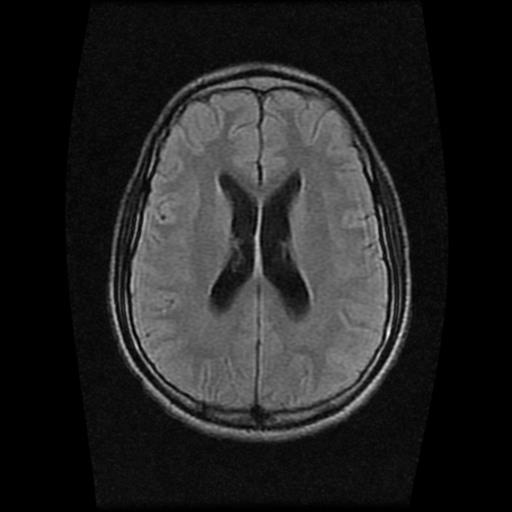 File:Brainstem glioma (Radiopaedia 30923-31624 Axial FLAIR 15).jpg