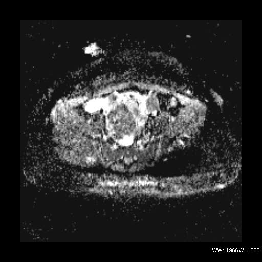 File:Broad ligament fibroid (Radiopaedia 49135-54241 Axial ADC 13).jpg