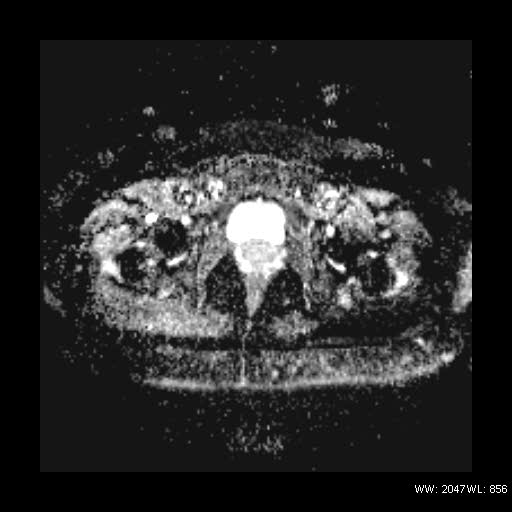 File:Broad ligament fibroid (Radiopaedia 49135-54241 Axial ADC 24).jpg
