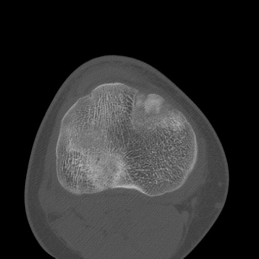 Brodie abscess of the tibia (Radiopaedia 58984-66250 Axial bone window 65).jpg