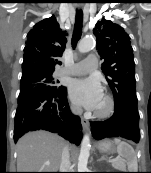 Bronchial artery aneurysms (Radiopaedia 42282-45385 Coronal C+ delayed 33).png