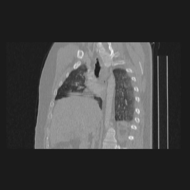 Bronchial atresia (Radiopaedia 60685-68439 Sagittal lung window 40).jpg