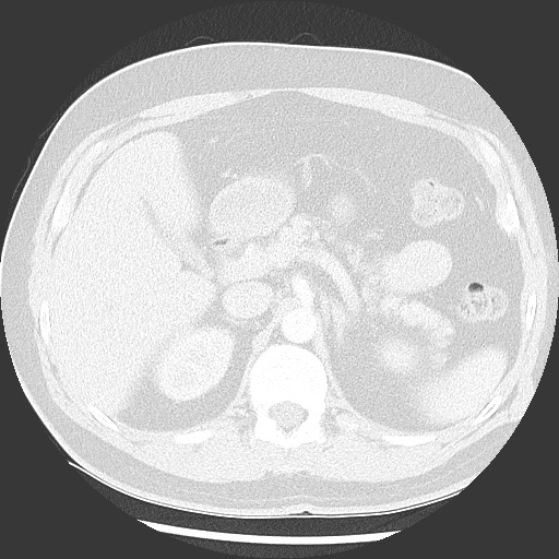 Bronchial carcinoid tumor (Radiopaedia 67377-76764 Axial lung window 65).jpg