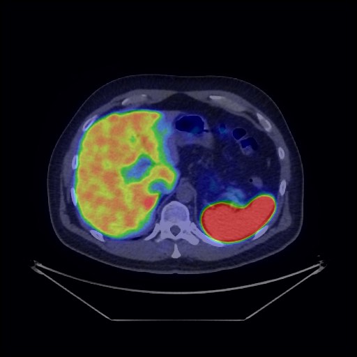Bronchial carcinoid tumor (Radiopaedia 67377-76765 68Ga-DOTATATE PET-CT 41).jpg