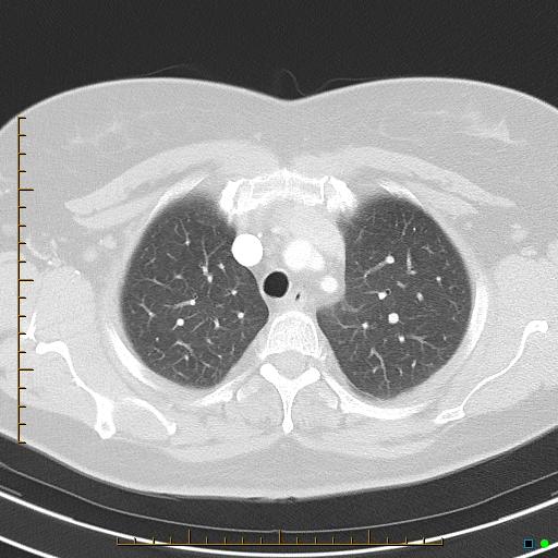 Bronchial diverticula (Radiopaedia 79512-92675 Axial lung window 12).jpg