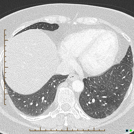 Bronchial diverticula (Radiopaedia 79512-92676 Axial lung window 158).jpg