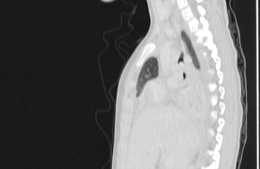Bronchial mucoepidermoid carcinoma (Radiopaedia 57023-63895 Sagittal lung window 59).jpg