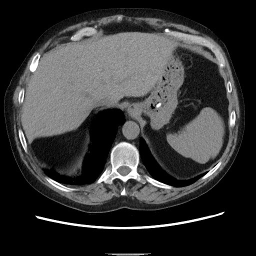 Bronchial stenosis - lung transplant (Radiopaedia 73133-83848 Axial non-contrast 53).jpg