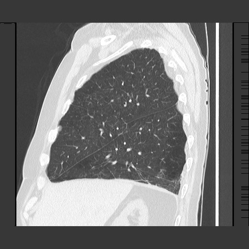 Bronchial stenosis - lung transplant (Radiopaedia 73133-83848 Sagittal lung window 20).jpg