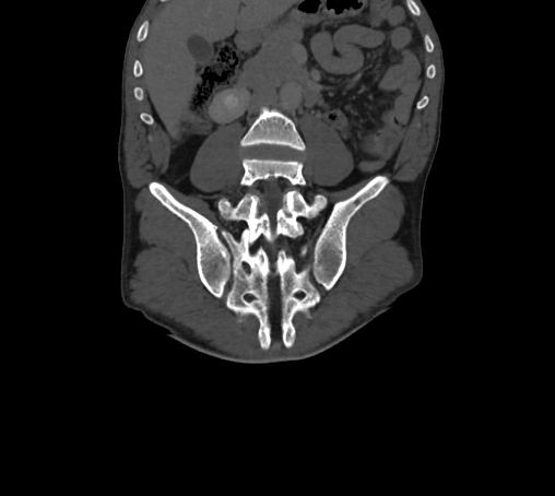 Bronchiectasis in Crohn disease (Radiopaedia 60311-67977 Coronal bone window 47).jpg