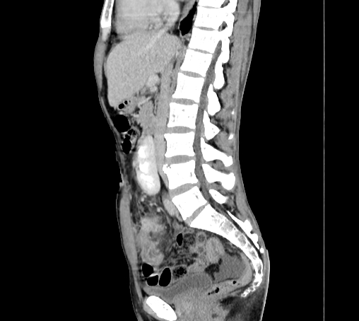 File:Bronchiectasis in Crohn disease (Radiopaedia 60311-67977 D 53).jpg