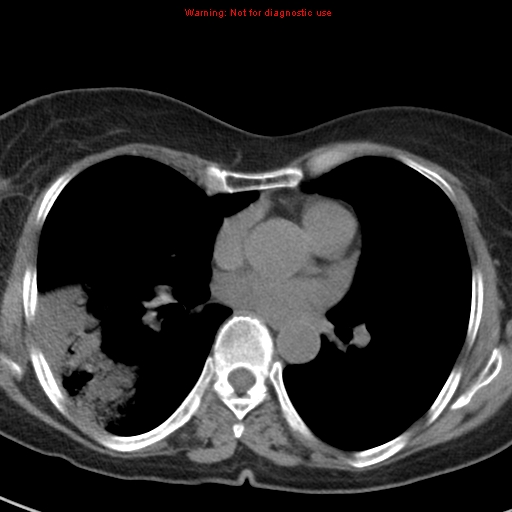 File:Bronchoalveolar carcinoma (BAC) (Radiopaedia 13436-13392 Axial non-contrast 29).jpg