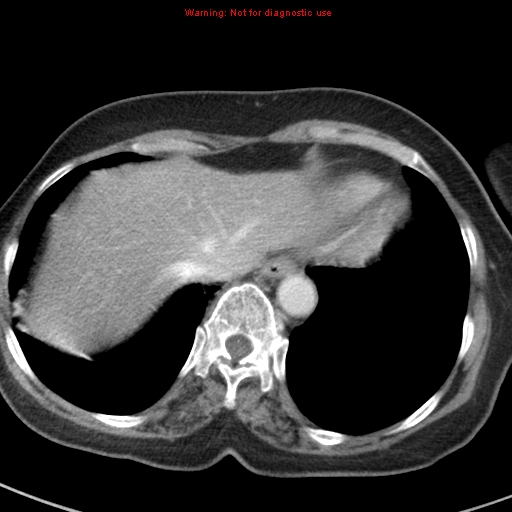 File:Bronchoalveolar carcinoma (BAC) (Radiopaedia 13436-13392 B 44).jpg