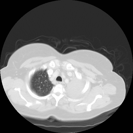 Bronchogenic carcinoma (Radiopaedia 73497-84262 Axial lung window 20).jpg