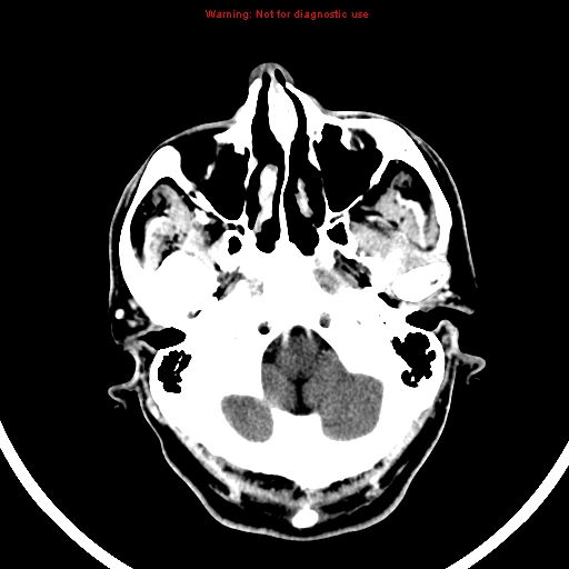 File:Bronchogenic carcinoma brain metastasis (Radiopaedia 9286-9970 B 4).jpg