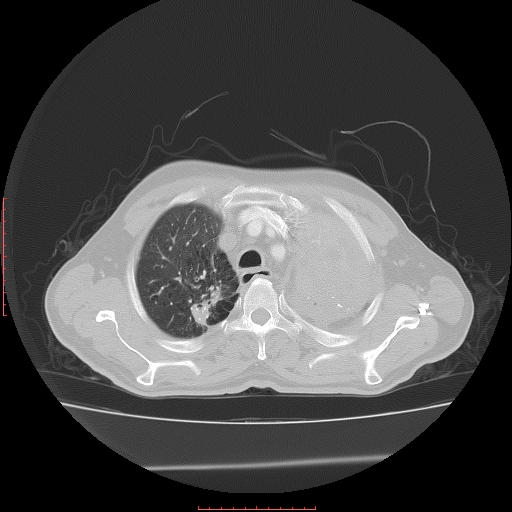 File:Bronchogenic carcinoma with left atrial large deposit - T4N3M1a (Radiopaedia 42316-45428 Axial lung window 8).jpg