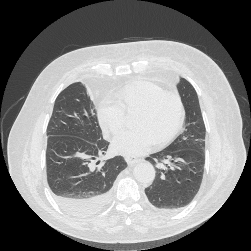 Bronchogenic carcinoma with metastatic lymphadenopathy (Radiopaedia 37671-39569 Axial lung window 35).jpg