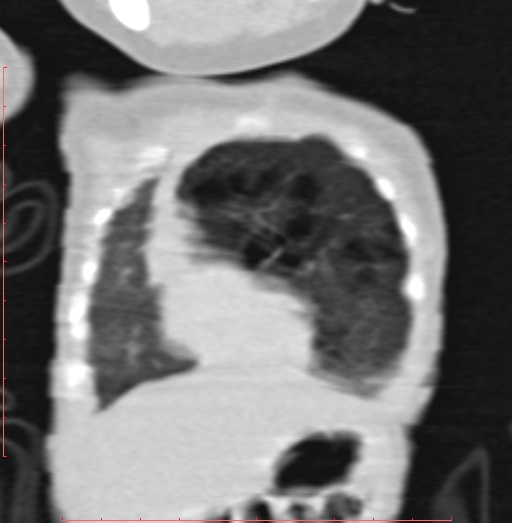 Bronchogenic cyst (Radiopaedia 78599-91409 Coronal lung window 45).jpg