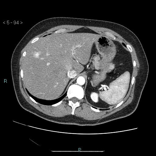 Bronchogenic cyst - posterior mediastinal (Radiopaedia 43885-47364 A 54).jpg