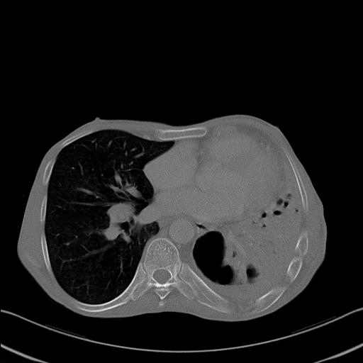 File:Bronchopleural fistula secondary to tuberculosis (Radiopaedia 20415-20322 Axial bone window 18).jpg