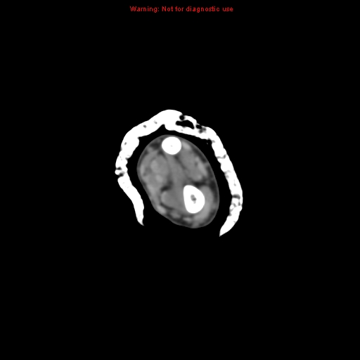 Brown tumor (Radiopaedia 12460-12694 Axial non-contrast 37).jpg