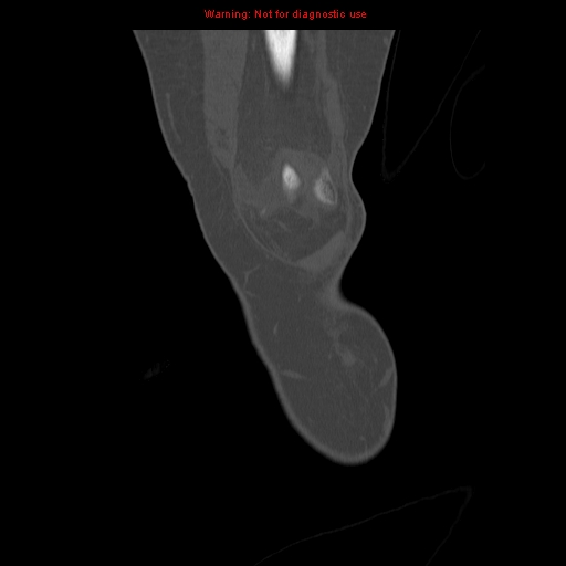 File:Brown tumors (Radiopaedia 9666-10291 Coronal bone window 1).jpg