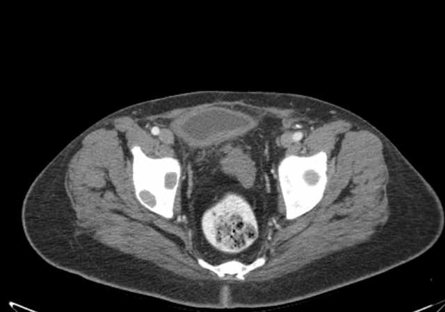File:Brown tumors compressing the spinal cord (Radiopaedia 68442-77988 E 113).jpg