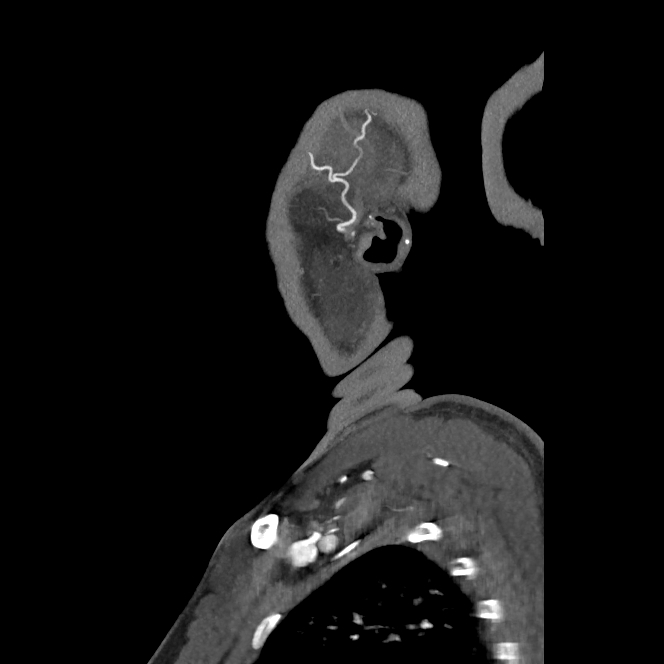 Buccal fat pad arteriovenous malformation (Radiopaedia 70936-81144 C 71).jpg