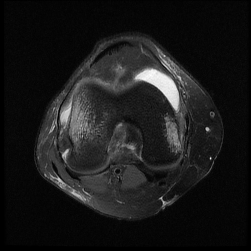 File:Bucket handle meniscus tear (Radiopaedia 56916-63751 Axial PD fat sat 10).jpg